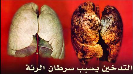 80% من سرطان الرئة ناتج عن التدخين
