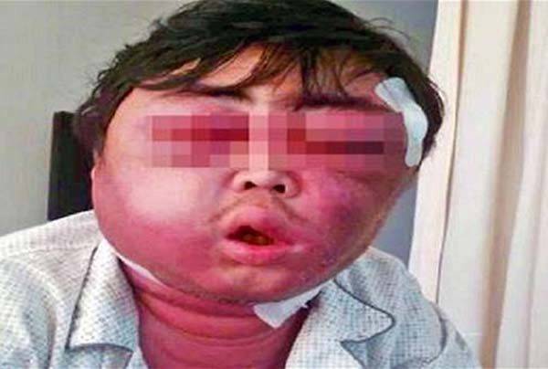 انتفاخ وجه رجل صيني كالبالون بسبب قرصة بعوضة