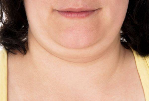 تخلصوا من الذقن المزدوج مع "kybella"