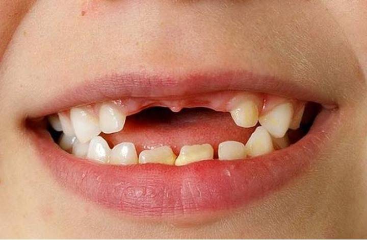 تقنية جديدة لعلماء بريطانيون لعلاج الأسنان بلا ألم