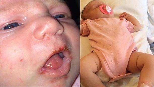 أم تنشر صوراً مرعبة: لا تدعوا أحداً يقبّل أطفالكم