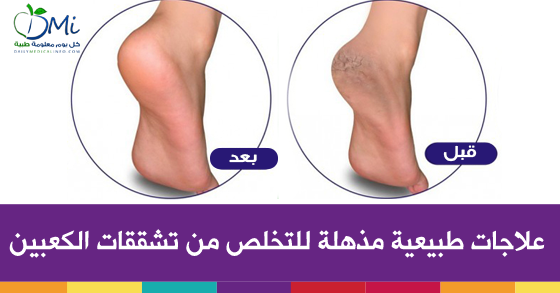 ما سبب تشقق القدمين و ما الطرق الطبيعية للتخلص من هذه التشققات من المنزل ؟