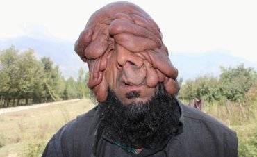 رجل لا يمتلك وجها طبيعيا ويعيش على التسول!