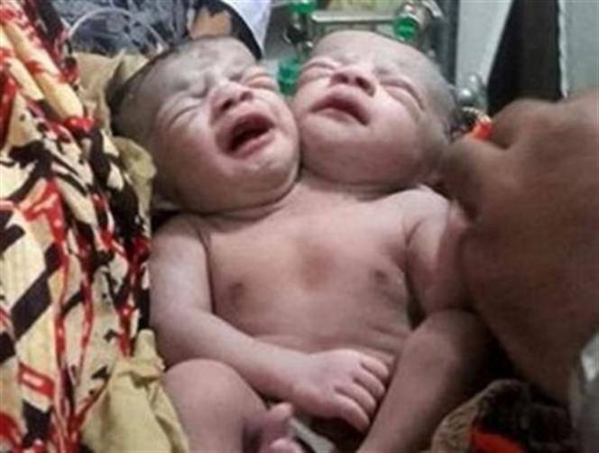 حالة نادرة وصادمة..ولادة طفلة برأسين