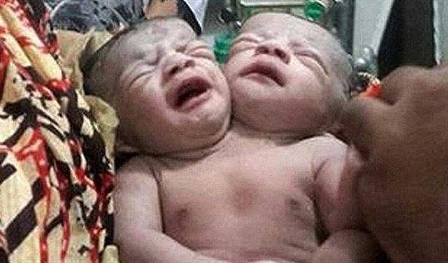 بالصورة: طفلة برأسين متكاملين وتأكل بفميها الاثنين!!