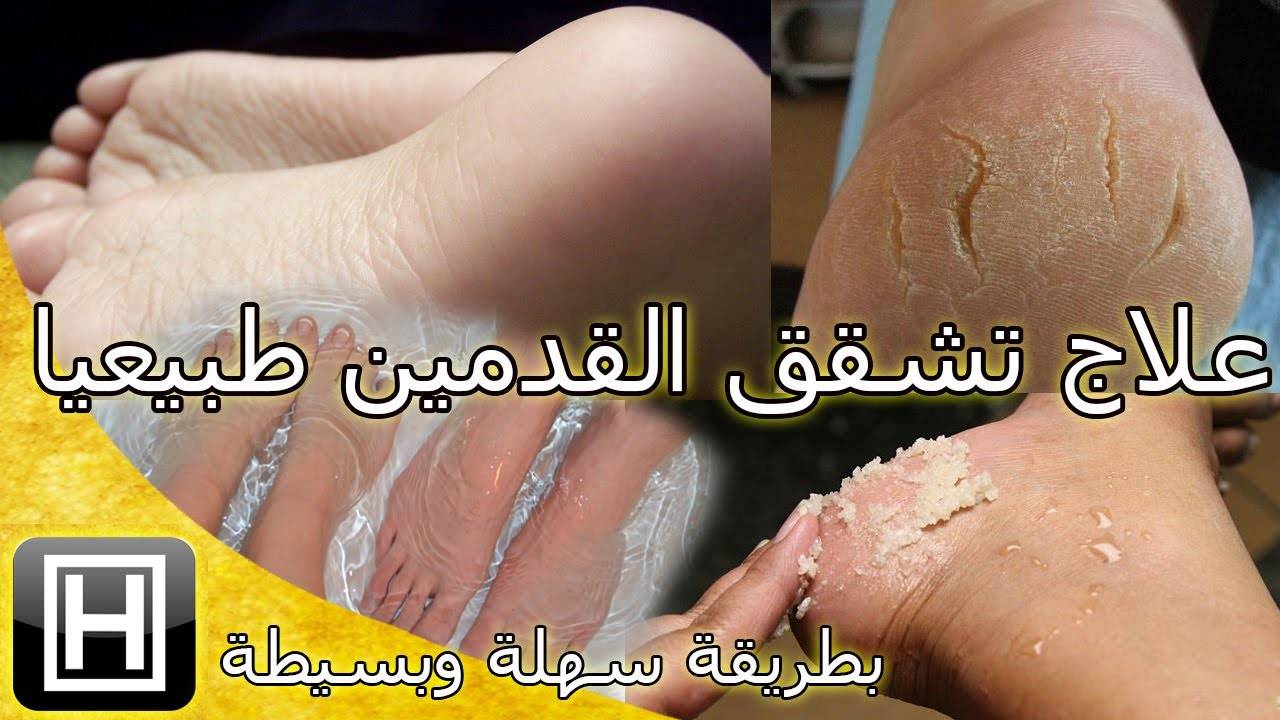 4 خطوات بسيطة لعلاج تشقق القدمين طبيعيا
