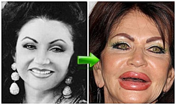 صور صادمة لأفشل و أبشع جراحات تجميل و نفخ الشفاه