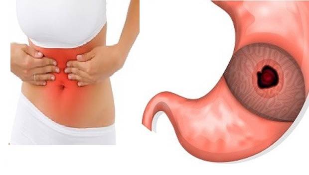 الأعراض ال 8 الأهم لقرحة المعدة ( وكيف نعالجها طبيعياً )