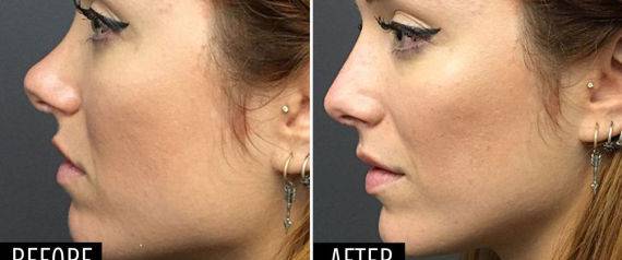 تجميل الأنف الآن في 15 دقيقة فقط وبدون جراحة..شاهد