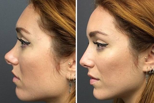 بالصور - تجميل الأنف من دون جراحة وفي 15 دقيقة فقط!