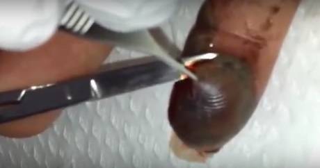 بالفيديو.. شاهد ماذا حدث ليد صياد أفاع تعرض إلى لدغة أفعى سامة