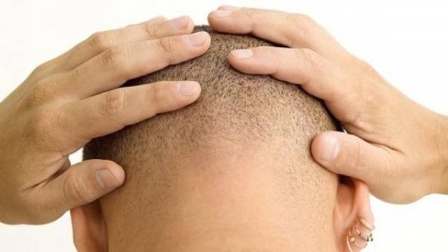 اكتشاف مبهر- تقنية جديدة لزرع الشعر ومكافحة الصلع!