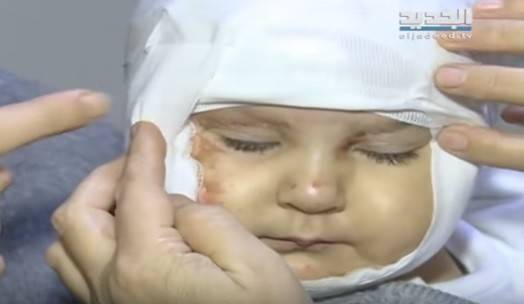 بالفيديو.. وجه ابنة 10 أشهر مهدد بالتشوه