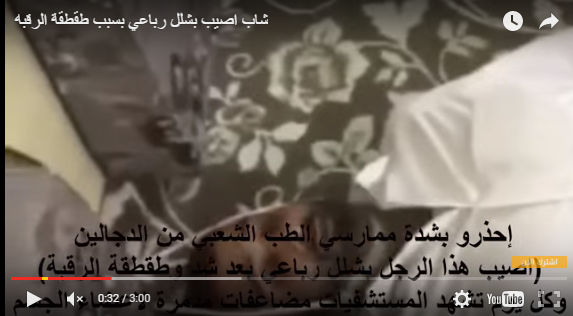 بالفيديو.. إصابة شاب بالشلل الرباعي أثناء «طقطقة رقبته»