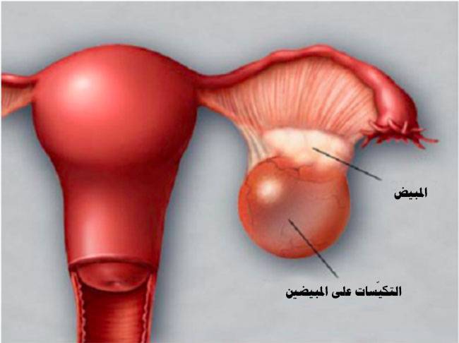 5 عادات تضرّ بصحّة المبيض عند المرأة