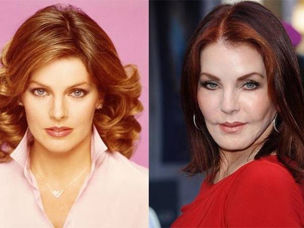 10 صور لنجوم دمّروا مظهرهم بفعل عمليات التجميل الكارثيّة