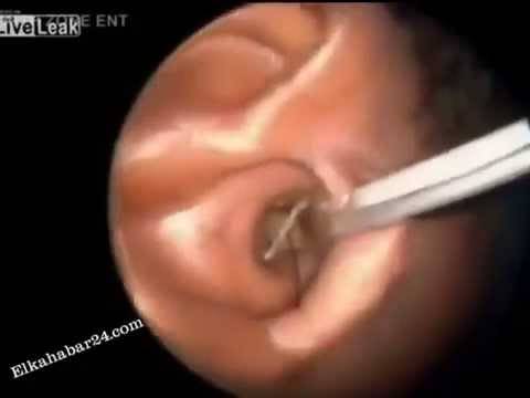 فيديو للكبار فقط- لن تصدق ما يخرج من أذن هذه الفتاة يومياً!