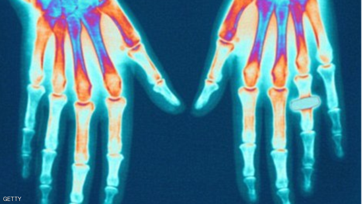 دراسة: عمال النسيج أكثر عرضة لالتهاب المفاصل.