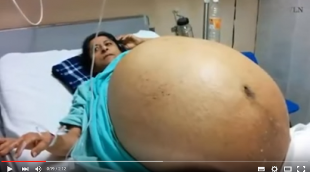 إمرأة تزن أكثر من 275 كيلو.. شاهد ماذا وجدوا داخل جسمها! .. فيديو
