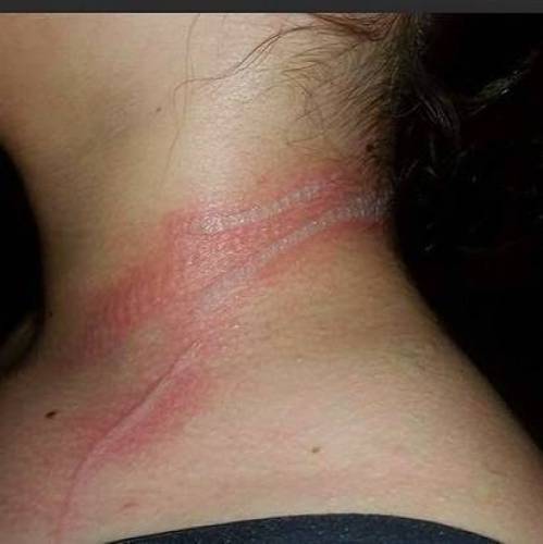 بالصور- كيف تسبب هاتف ذكيّ بحروقٍ خطيرة لهذه الطفلة!