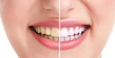 احذر تلك العادات التى ستدمر اسنانك