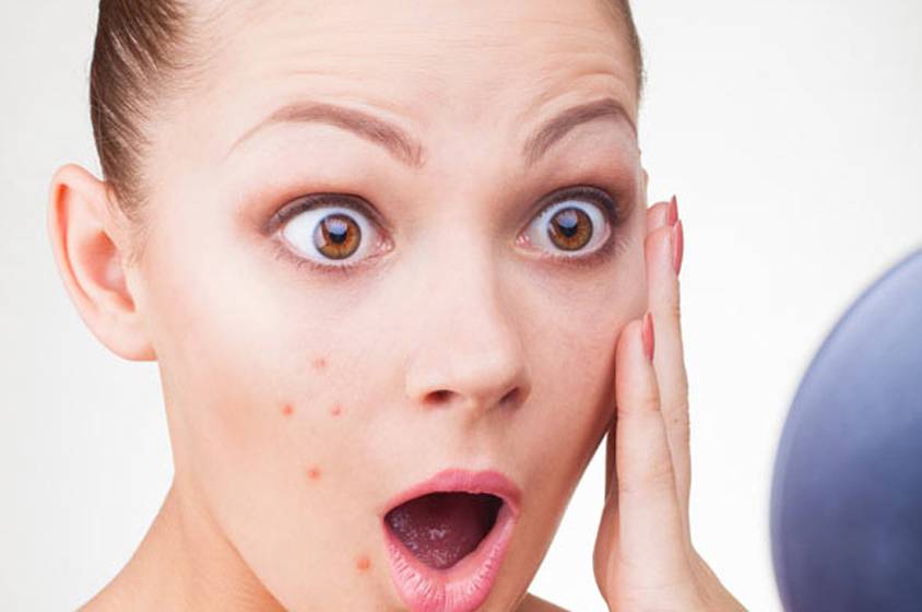 9 أسباب خفيّة لمشكلة حَبّ الشّباب .. اكتشِفوها الآن وتجنّبوها