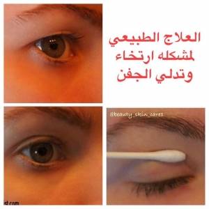 العلاج الطبيعي لمشكلة ارتخاء وتدلي الجفن