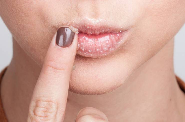 للتخلص من الاسوداد حول الفم...7 خطوات سريعة وسهلة
