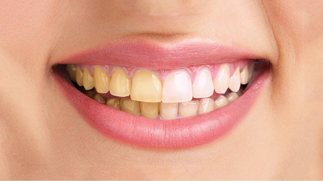 هذه هي المأكولات التي تسبب إصفرار الأسنان..فتجنبوها