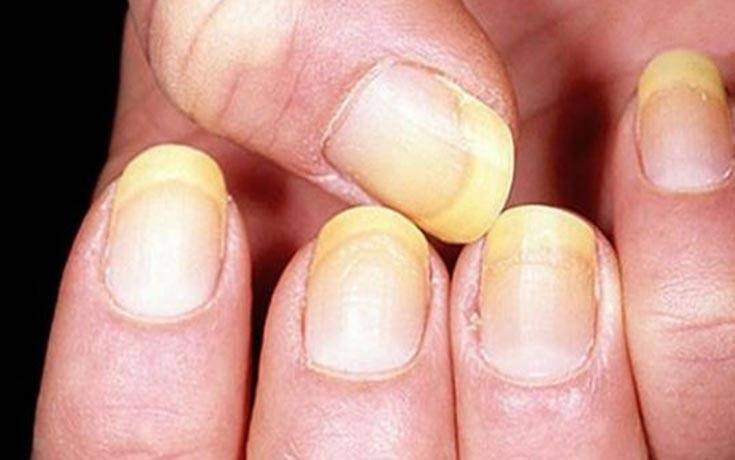 5 علامات على أظافركم تكشف إصابتكم بمرض خطير
