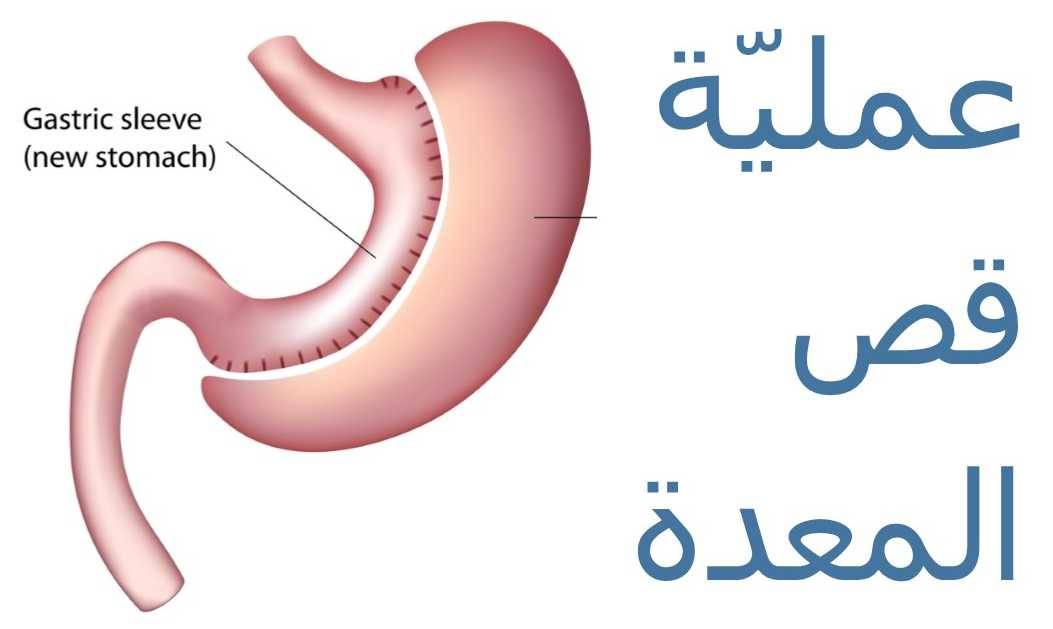 بالفيديو – هكذا تتم عملية قصّ المعدة!
