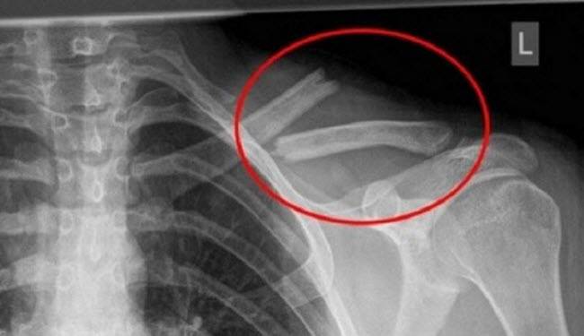 كيف يدمر هذا المشروب عظامك?!