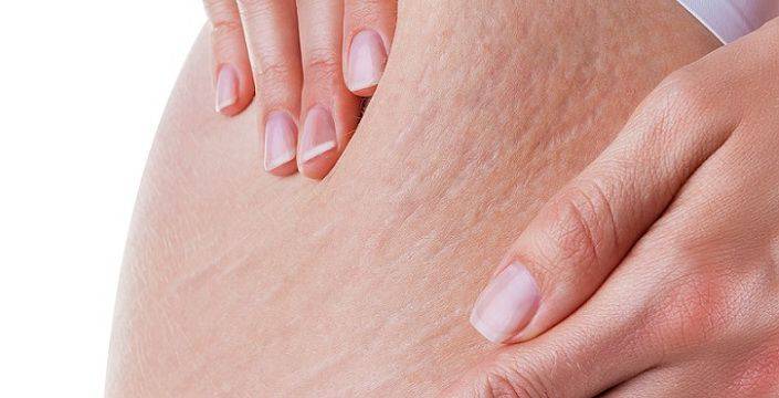 5 معلومات خاطئة عن علامات تمدد الجلد