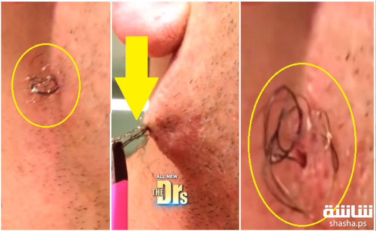 بالفيديو: ذهب للطبيب على أنه كيس دهن.. لكن ما وجدوه عكس توقعاتهم!