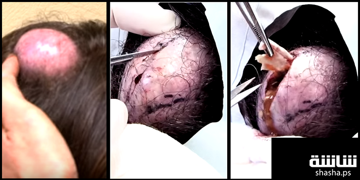 ظنت أنه انتفاخ طبيعي لمدة 20 عاماً.. و هذا ما وجده الأطباء!