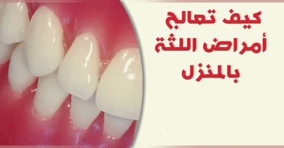 كيف تعالج أمراض اللثة بالمنزل