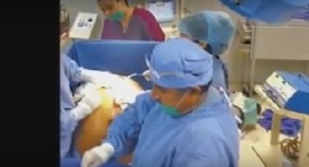 بالفيديو: إمرأة تزن أكثر من 275 كيلو.. شاهد ماذا وجدوا داخل جسمها!