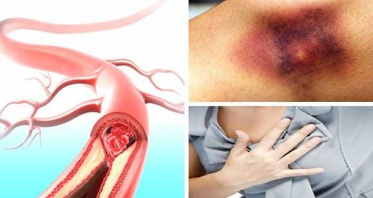 الجلطة الدموية قد تكون مميتة.. إليكم الإشارات والعوارض !!