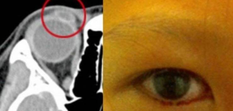 فتاة عمرها ١١ سنة وتذرف بدل الدمع دماً من عينها!