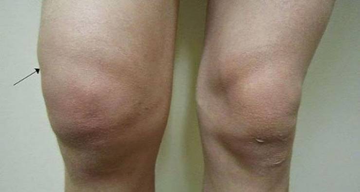 هل يحتبس الماء في ركبتيك ؟ إليك أخيراً حيلة طبيعية تريحك من المشكلة !!