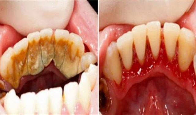 وصفة سحرية وسهلة للتخلص من رواسب الأسنان!
