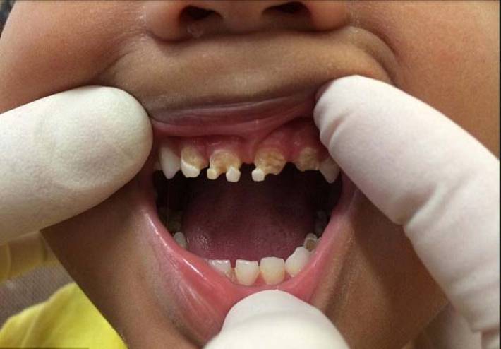 بالصور: طبيب الأسنان هذا اقتلع 11 سنًا من أسنان هذا الصبي الصغير