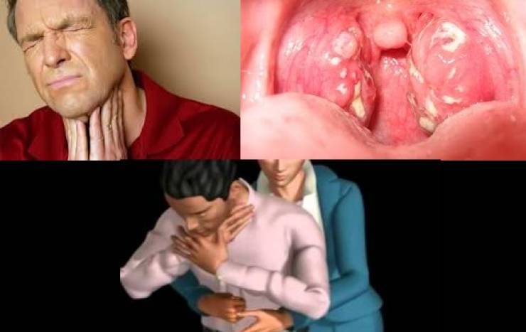 خدعة مذهلة لإزالة شوك السمك من الحلق في لحظات.. لن تصدق!