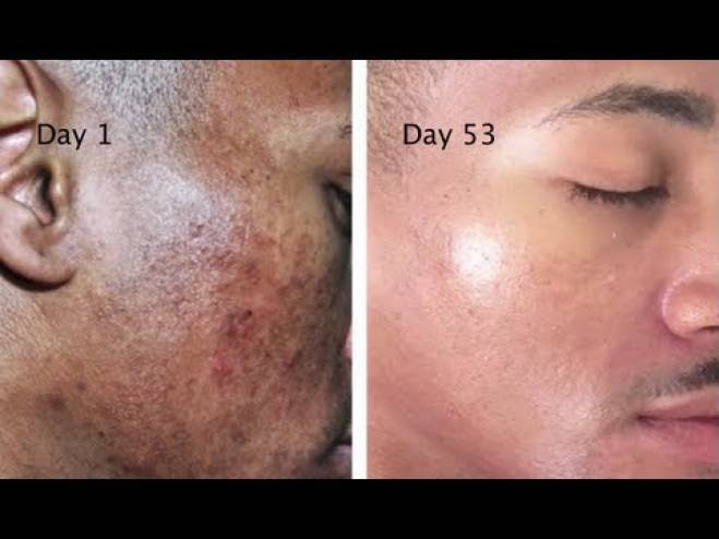 تخلص من البقع وآثار الحبوب على وجهك بمادتين فقط!