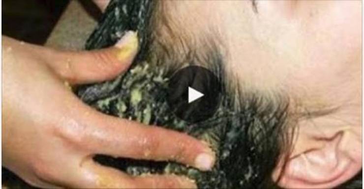 هل سمعت عن فوائد الثوم المذهلة للشعر؟!