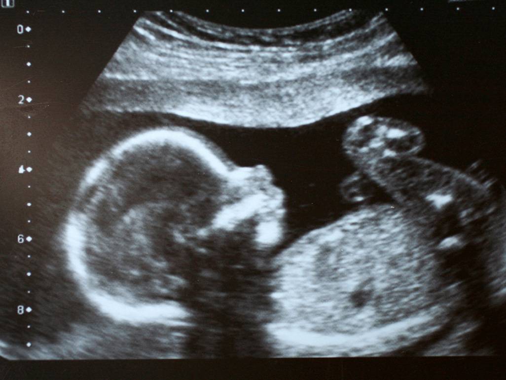 بالصورة.. أخرجوا توأمه من أحشائه.. بعد 15 عاما!