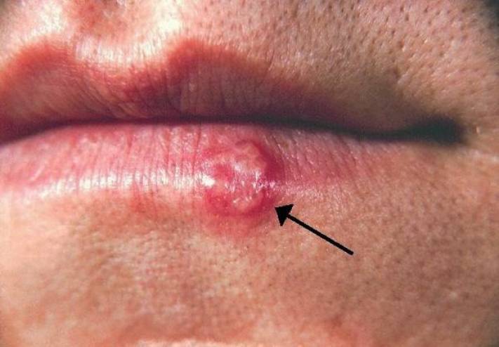 طرق طبيعية للتخلص من قرح الفم طبيعية