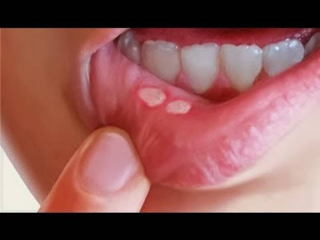 التخلص من قرح الفم بطرق طبيعية