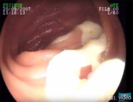 ظل يعاني من ألم المعدة  لمدة عامين...ما إكتشفه الأطباء أرعبهم