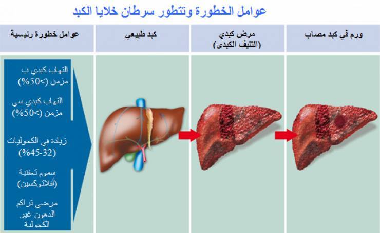 أعراض سرطان الكبد وكيفية الوقاية منه